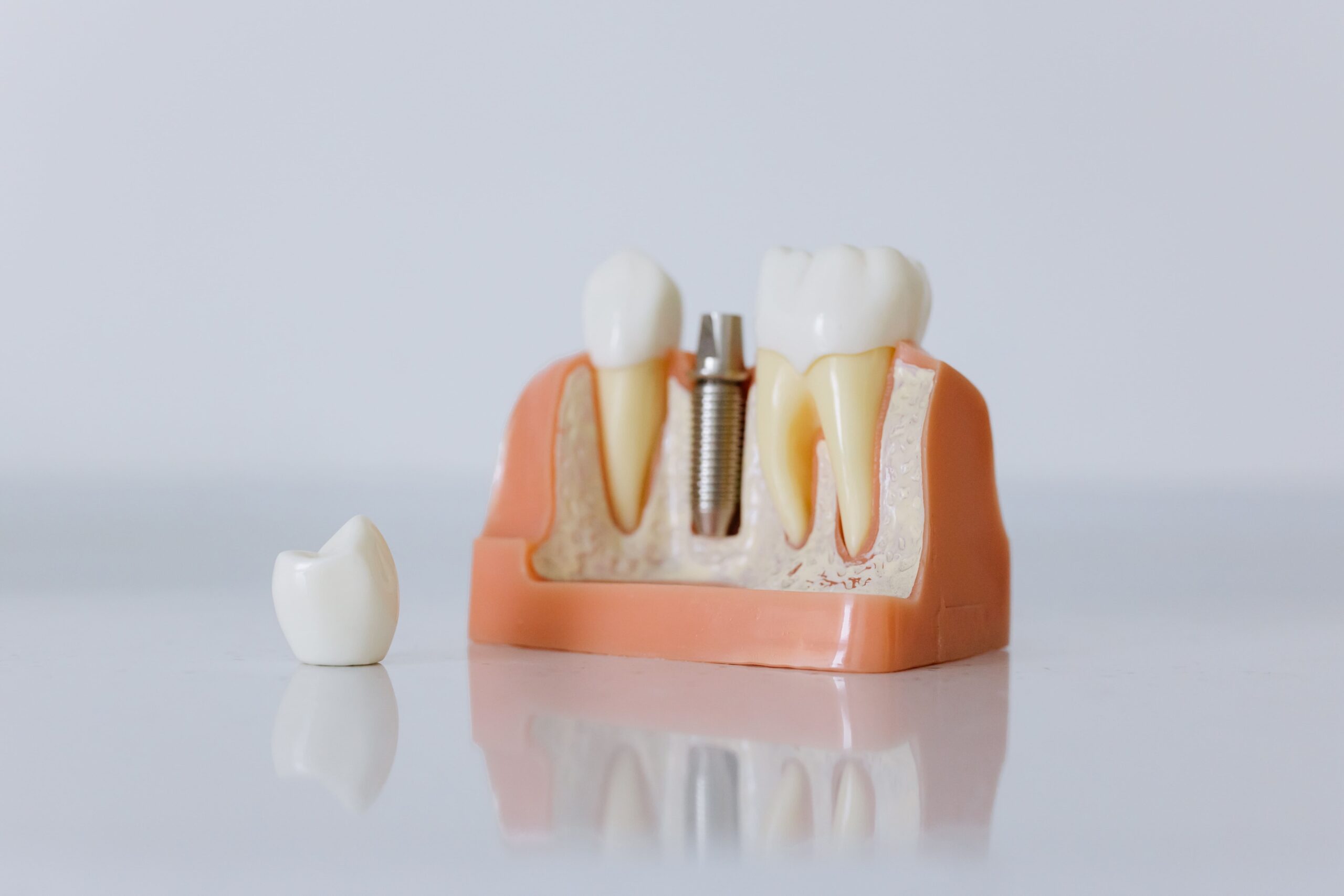 Implante dental sobre una dentadura ficticia