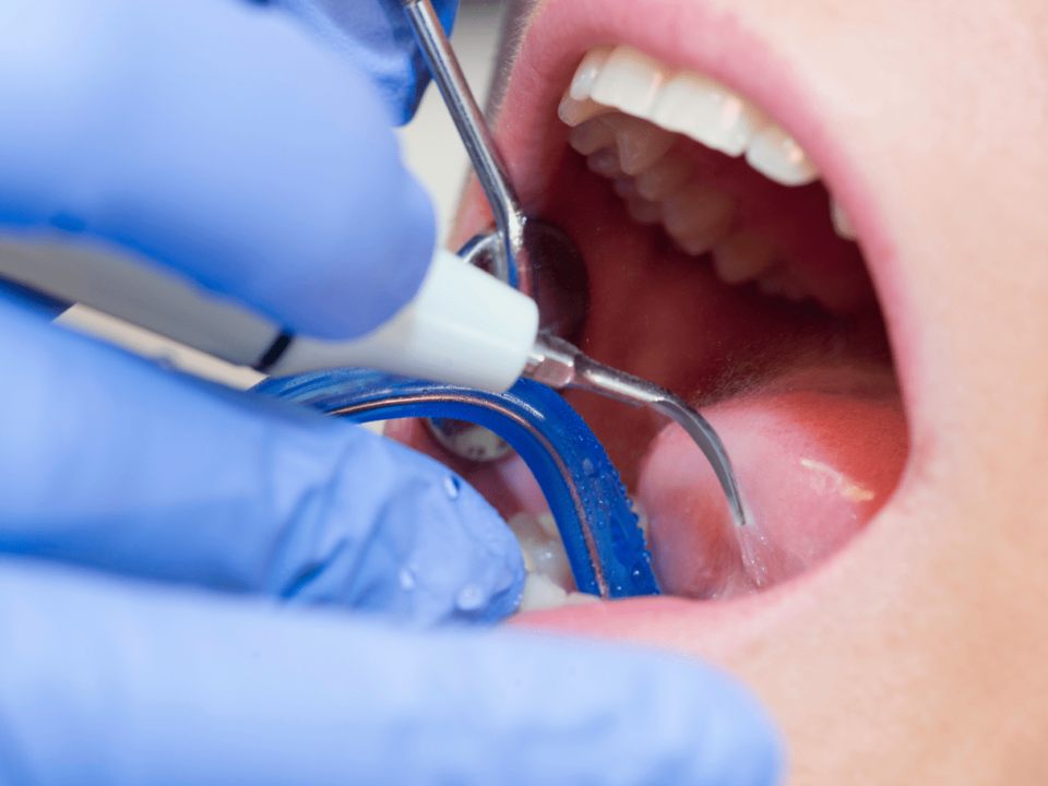 Paciente sometido a un tratamiento para eliminar el sarro dental