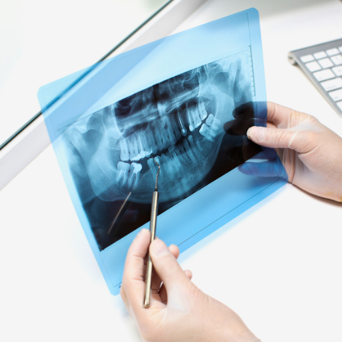 radiografía implante dental en Málaga
